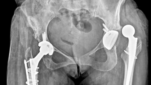 Röntgenbild zweier künstlicher Hüftgelenke – beidseitige Hüftimplantate nach schweren Sturzfolgen.