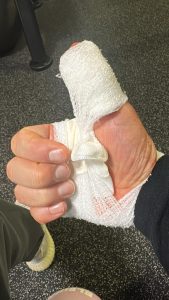 Verbundener Daumen nach Unfall – persönlicher Erfahrungsbericht aus der Notaufnahme von Personaltrainer Stuttgart.